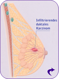 Infiltrierendes duktales Karzinom