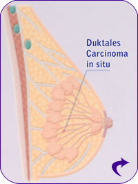 Duktales Karzinom in Situ