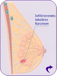 Infiltrierendes lobuläres Karzinom