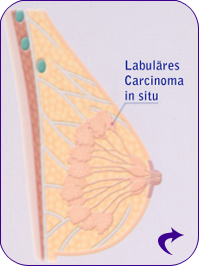 Lobuläres Karzinom in Situ