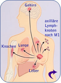 Wohin wanderen Krebszellen