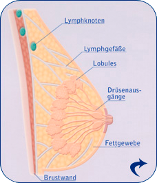 Brust mit nicht befallenem Lymphknoten