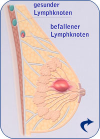 Brustkrebs mit befallenem Lymphknoten