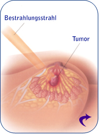 Bestrahlung des Tumors